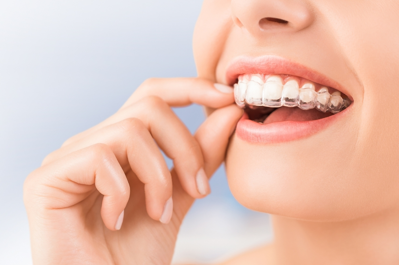 Invisalign vs Braces in Chennai: Which Orthodontic Treatment Is Best in 2026?